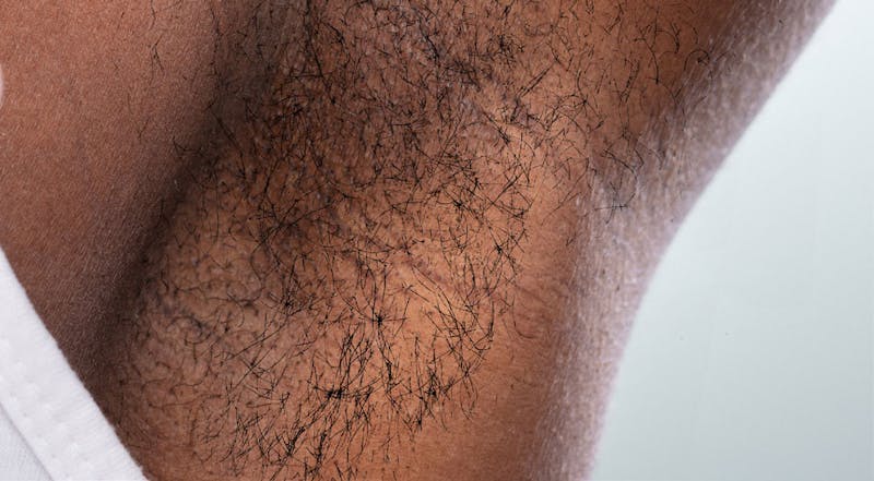 Laser Hair Removal Before & After Gallery - Patient 237566 - Image 1