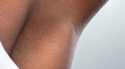 Laser Hair Removal Before & After Gallery - Patient 237566 - Image 2
