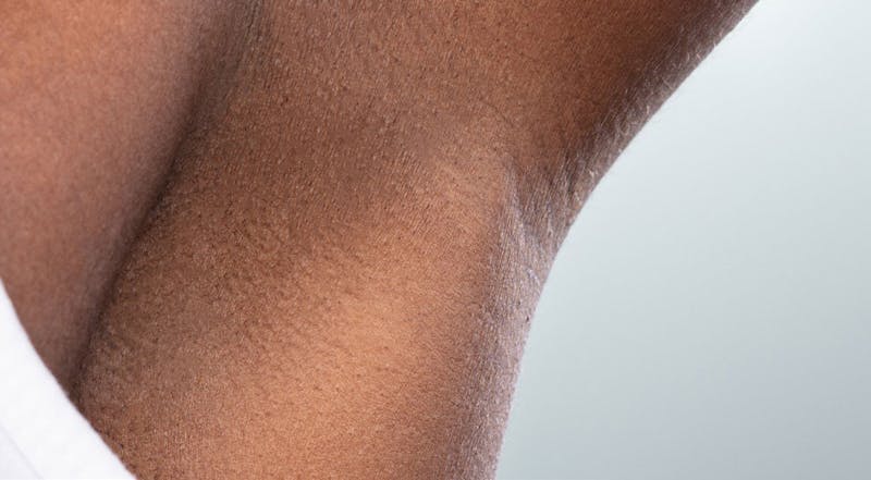 Laser Hair Removal Before & After Gallery - Patient 237566 - Image 2