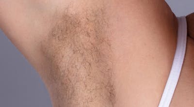 Laser Hair Removal Before & After Gallery - Patient 871508 - Image 1