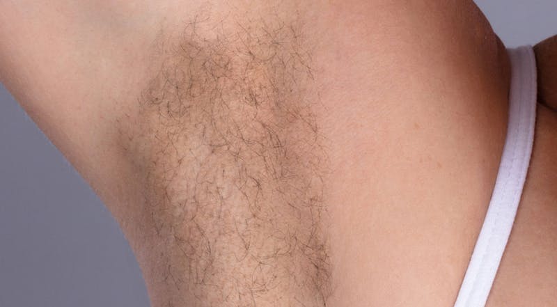 Laser Hair Removal Before & After Gallery - Patient 871508 - Image 1