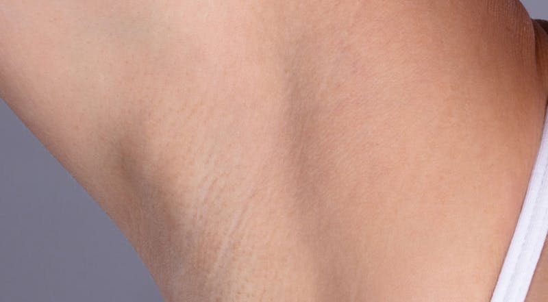 Laser Hair Removal Before & After Gallery - Patient 871508 - Image 2
