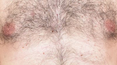 Laser Hair Removal Before & After Gallery - Patient 367159 - Image 1