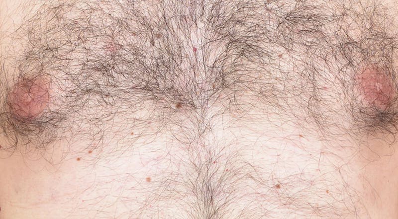 Laser Hair Removal Before & After Gallery - Patient 367159 - Image 1