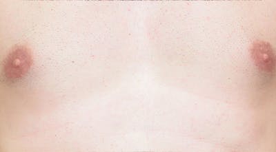 Laser Hair Removal Before & After Gallery - Patient 367159 - Image 2