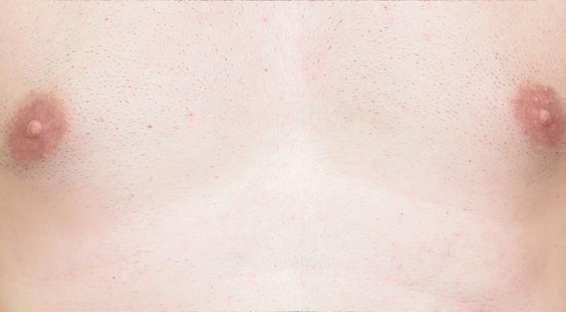 Laser Hair Removal Before & After Gallery - Patient 367159 - Image 2