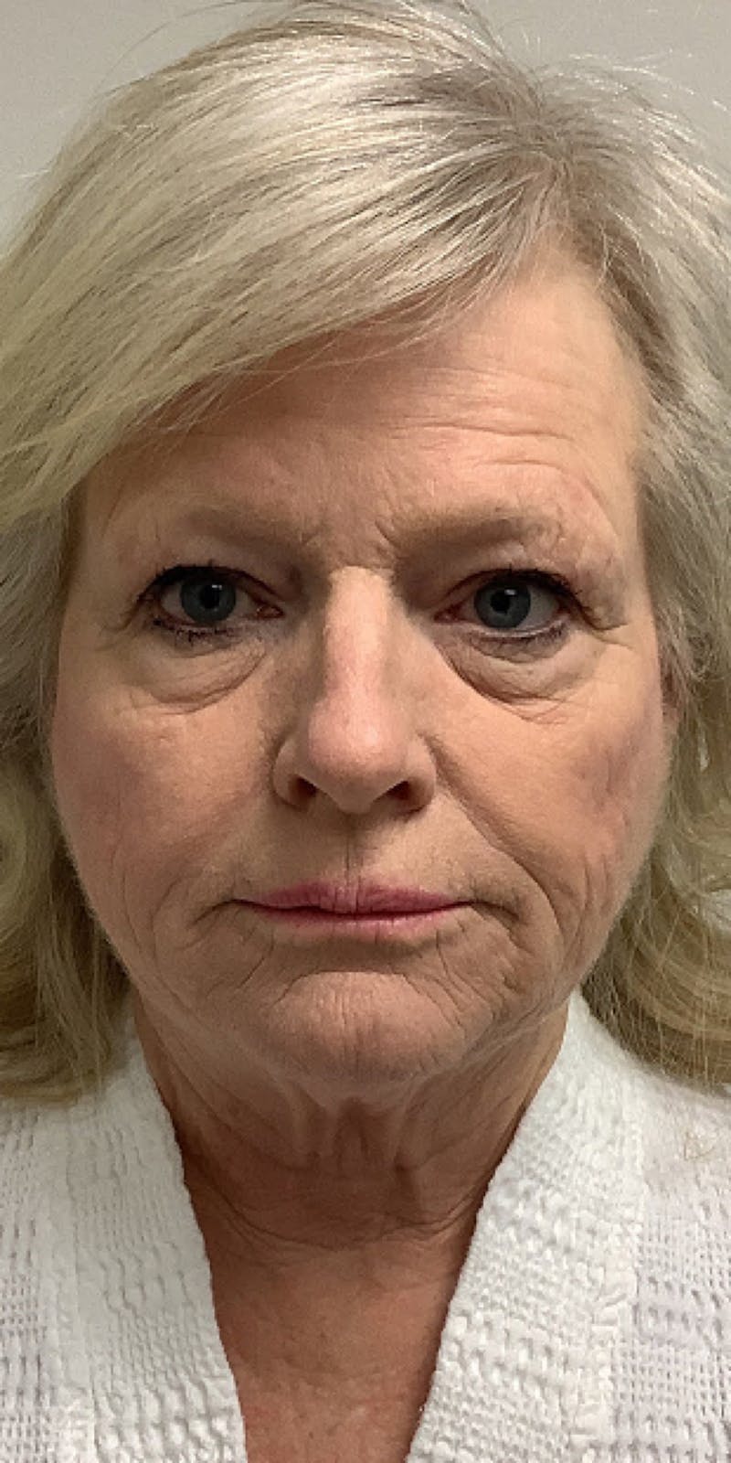 Laser Resurfacing Before & After Gallery - Patient 217102 - Image 1