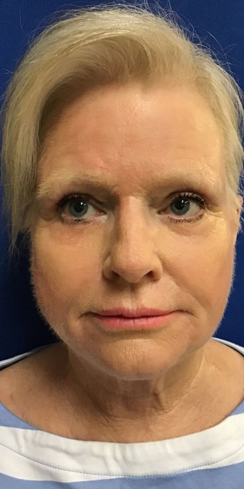 Laser Resurfacing Before & After Gallery - Patient 217102 - Image 2