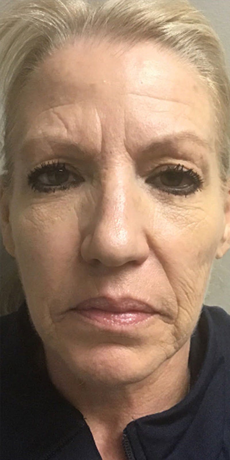 Laser Resurfacing Before & After Gallery - Patient 341558 - Image 1