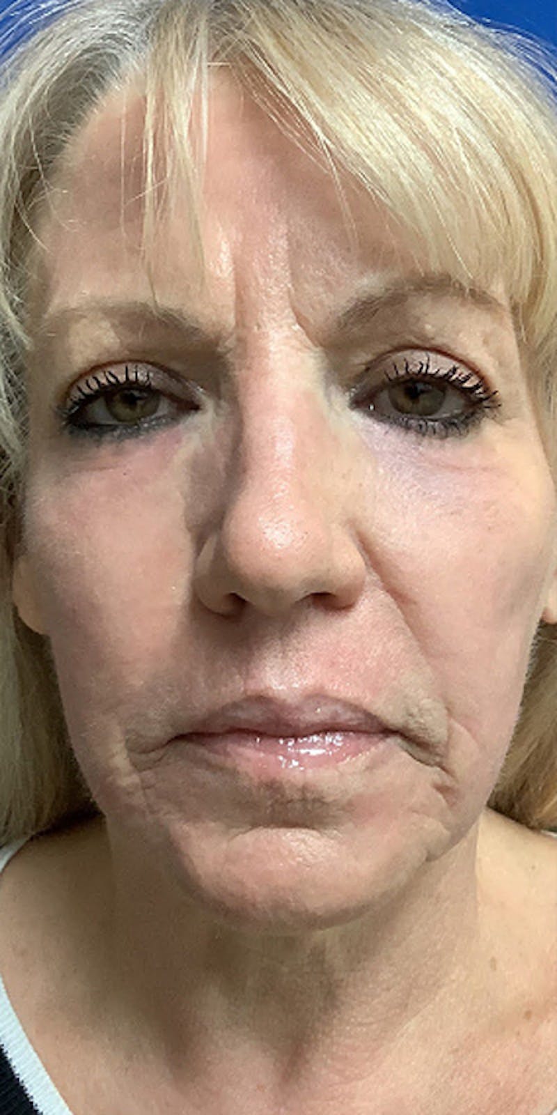 Laser Resurfacing Before & After Gallery - Patient 341558 - Image 2