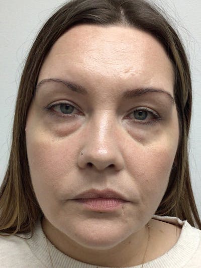 Laser Resurfacing Before & After Gallery - Patient 369865 - Image 1
