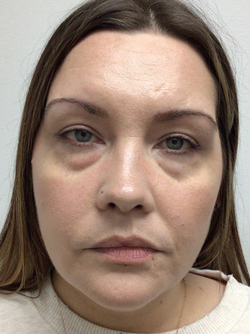 Laser Resurfacing Before & After Gallery - Patient 369865 - Image 1