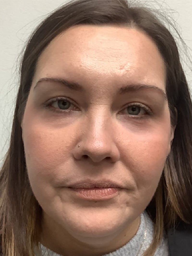 Laser Resurfacing Before & After Gallery - Patient 369865 - Image 2