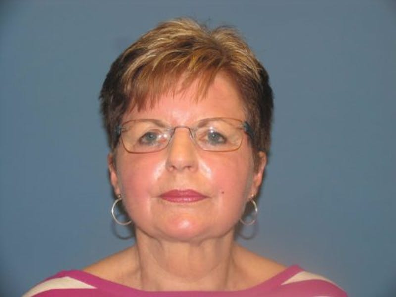 Laser Resurfacing Before & After Gallery - Patient 327285 - Image 2