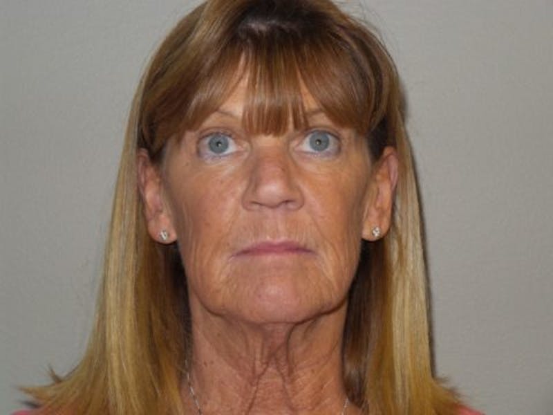 Laser Resurfacing Before & After Gallery - Patient 592338 - Image 1
