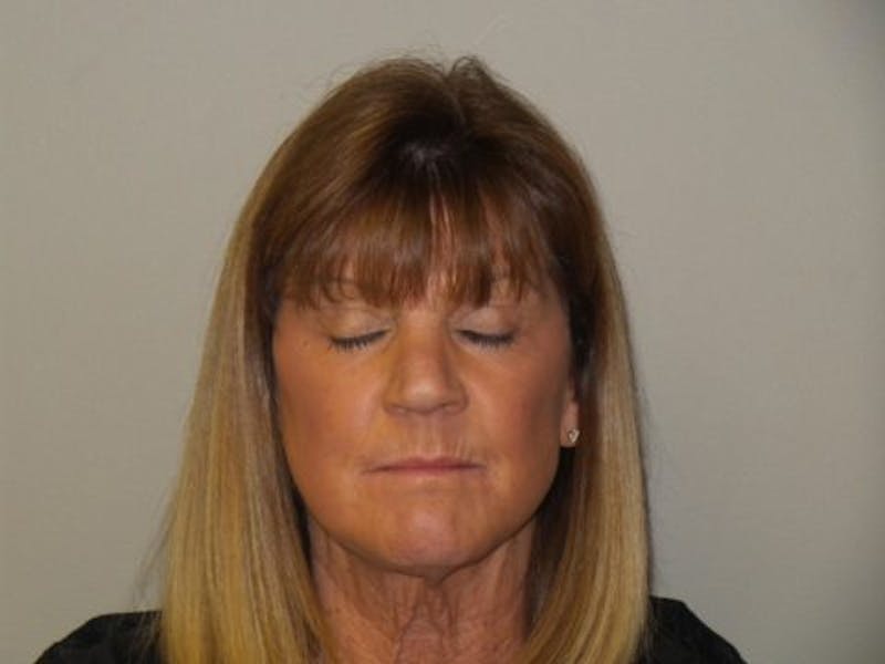 Laser Resurfacing Before & After Gallery - Patient 592338 - Image 2