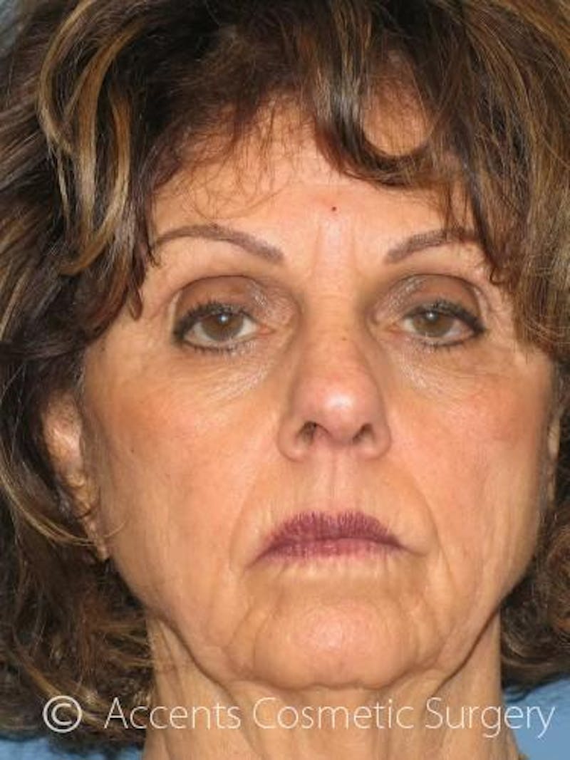 Laser Resurfacing Before & After Gallery - Patient 228374 - Image 1