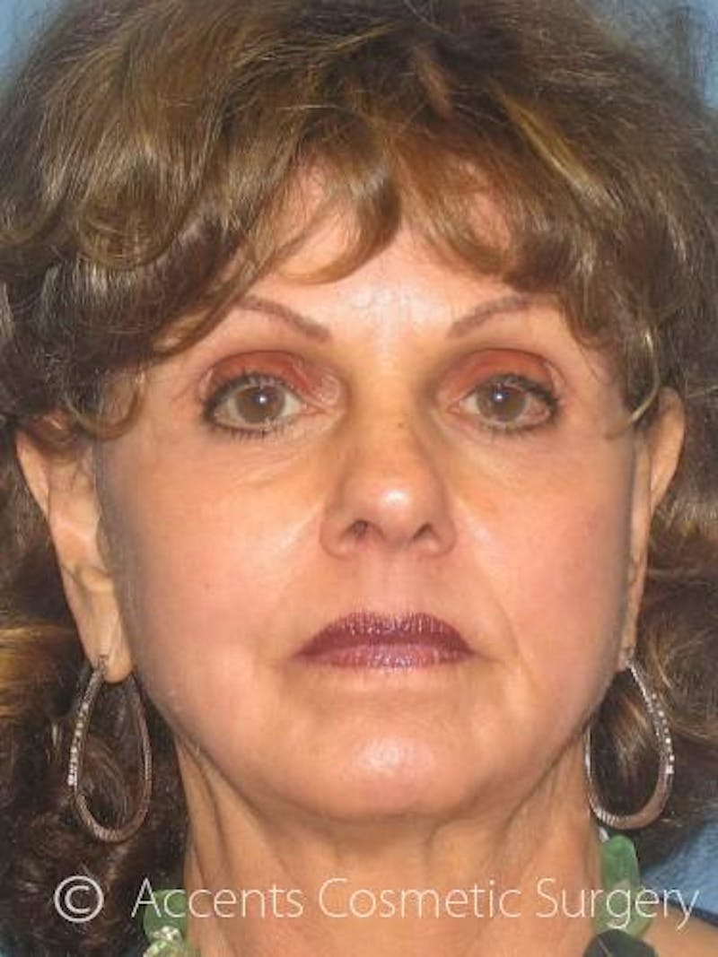 Laser Resurfacing Before & After Gallery - Patient 228374 - Image 2