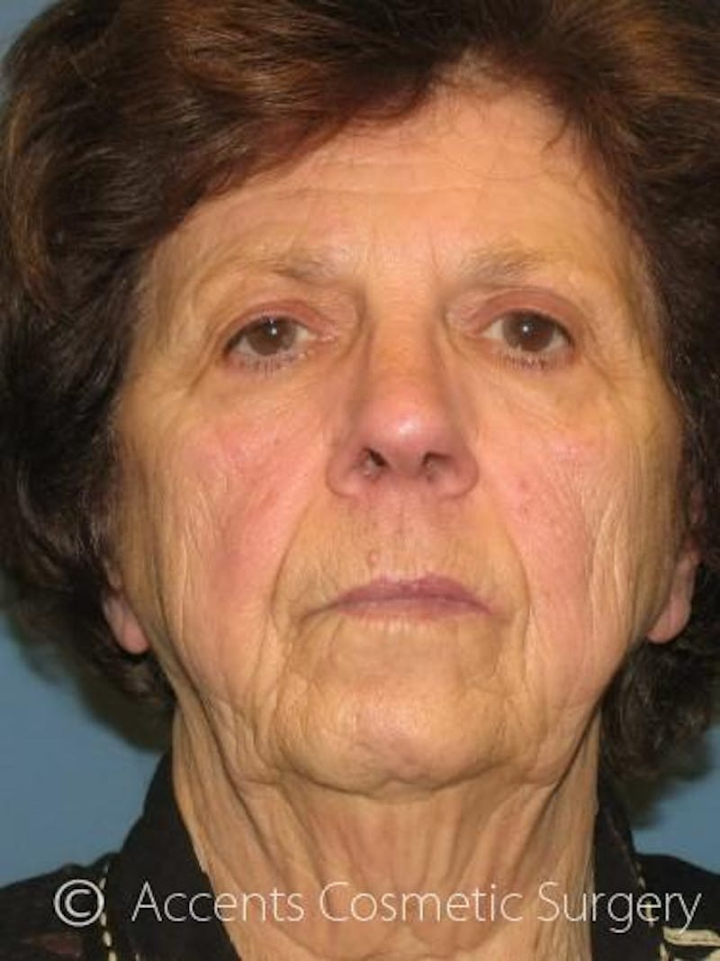 Laser Resurfacing Before & After Gallery - Patient 158715 - Image 1