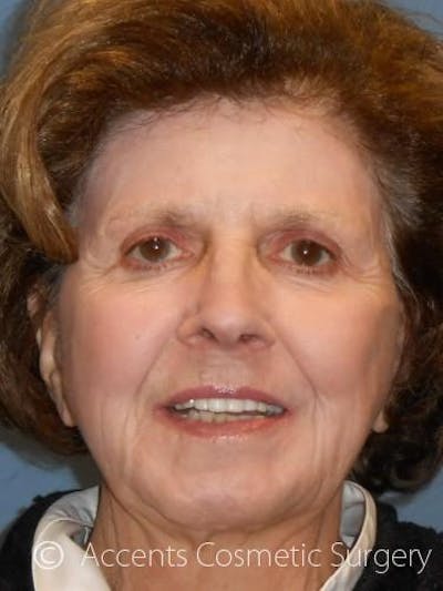 Laser Resurfacing Before & After Gallery - Patient 158715 - Image 2