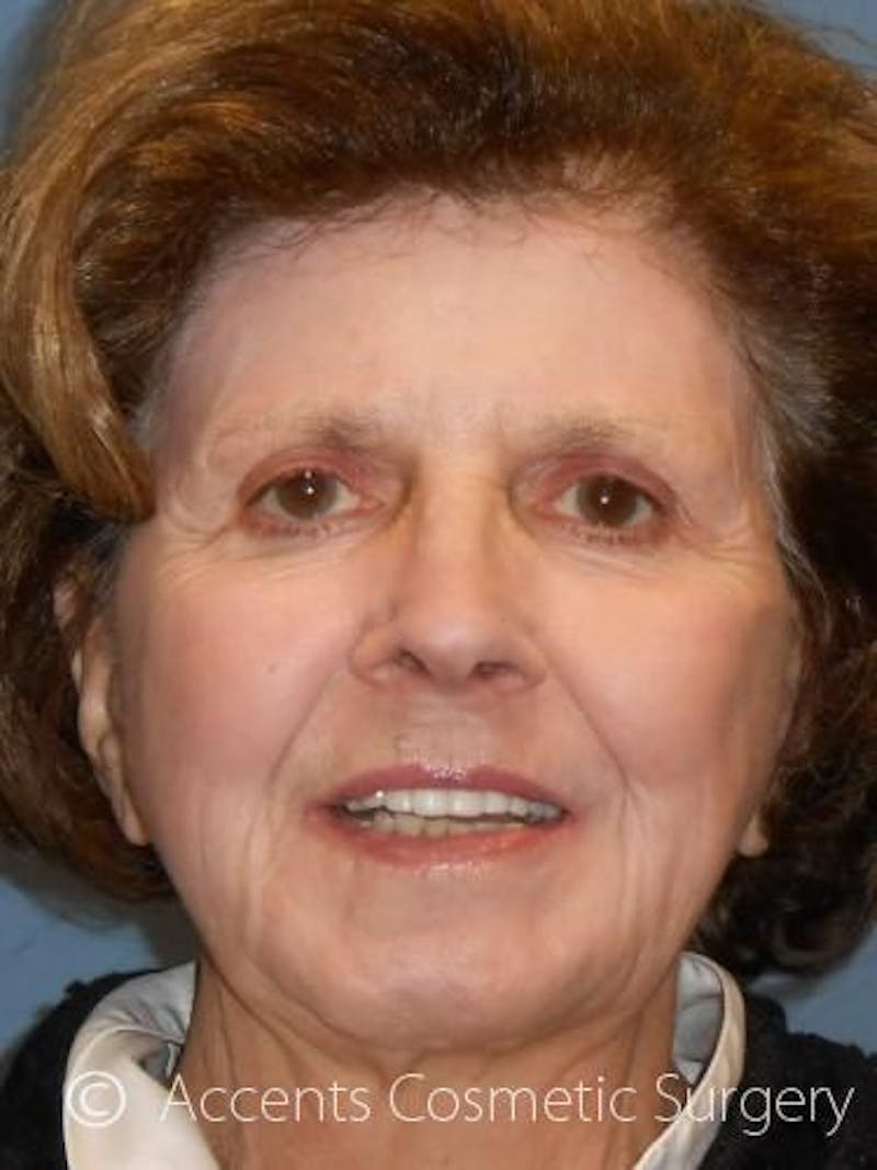 Laser Resurfacing Before & After Gallery - Patient 158715 - Image 2