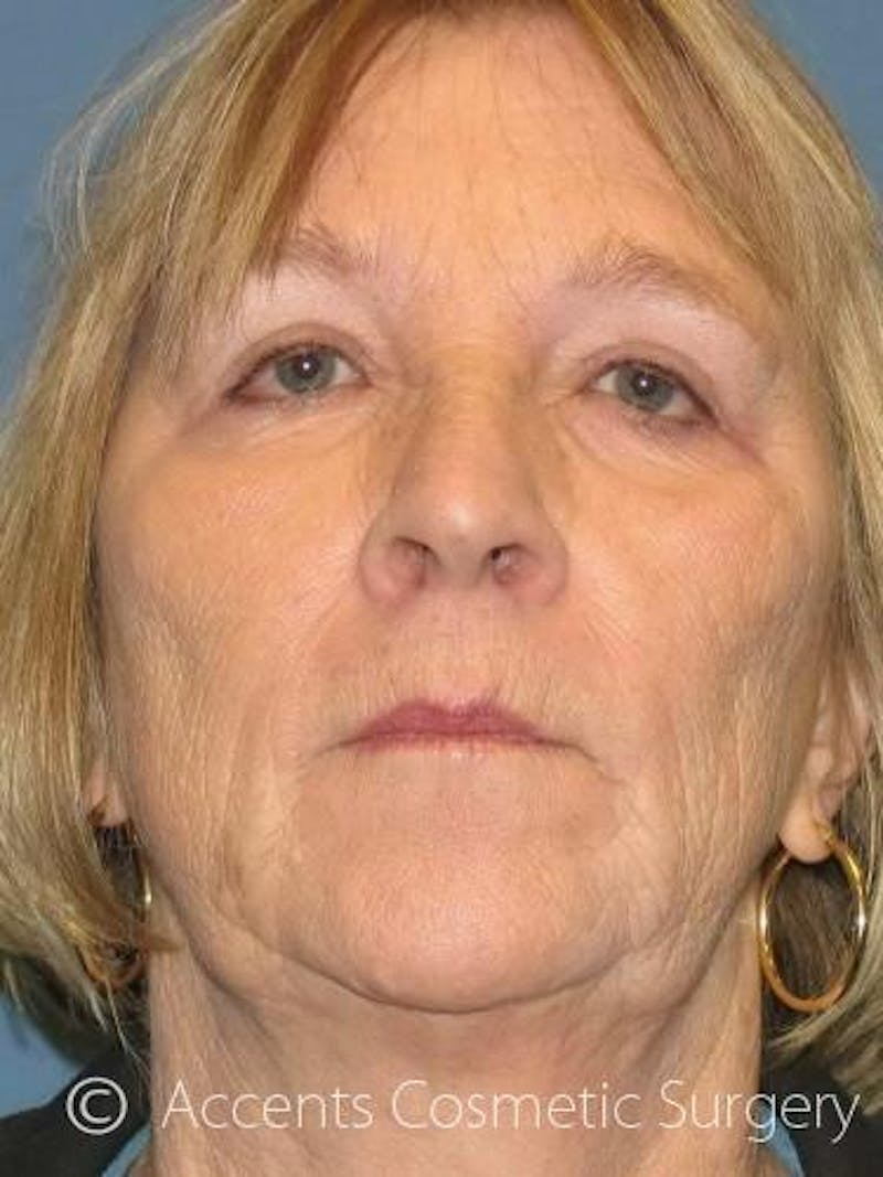 Laser Resurfacing Before & After Gallery - Patient 285388 - Image 1