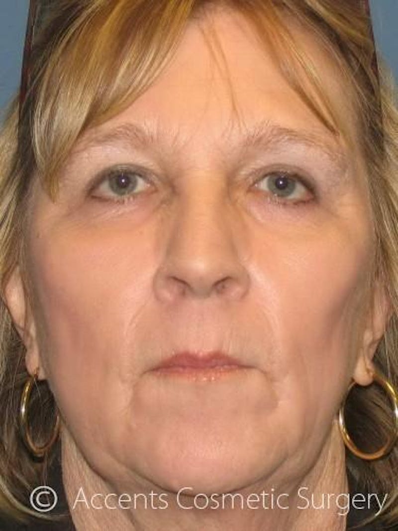 Laser Resurfacing Before & After Gallery - Patient 285388 - Image 2