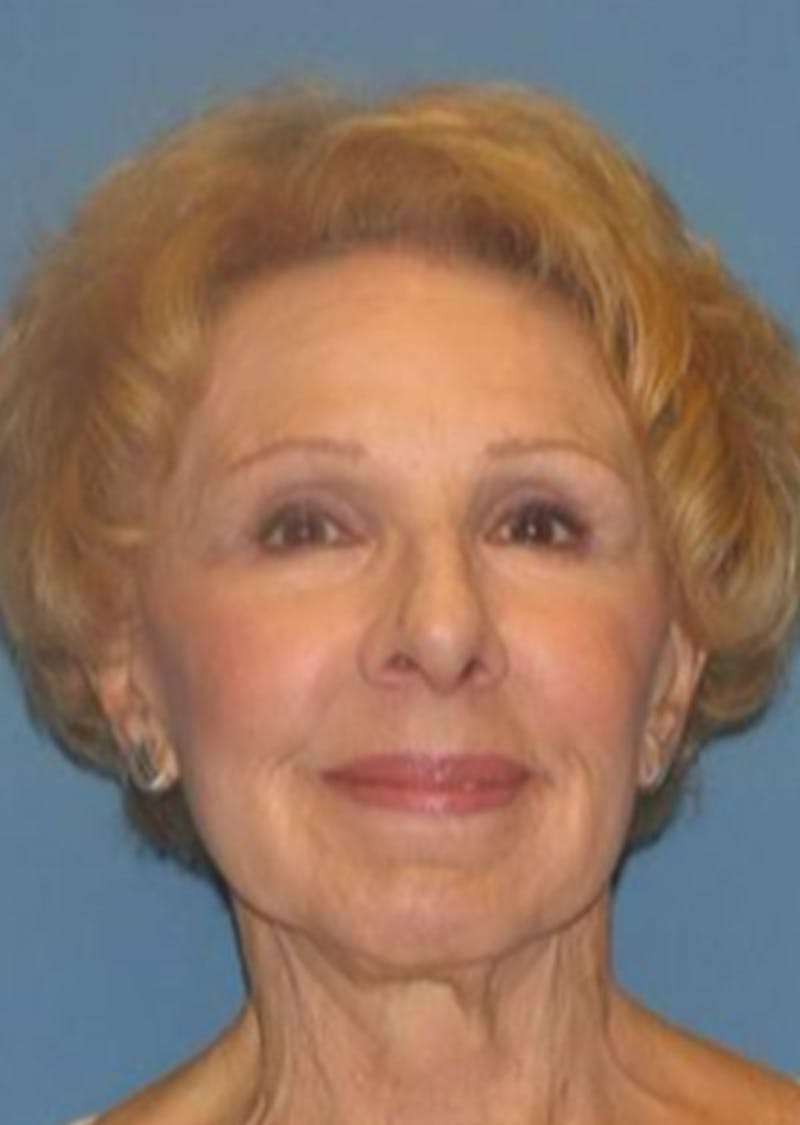 Laser Resurfacing Before & After Gallery - Patient 361687 - Image 2