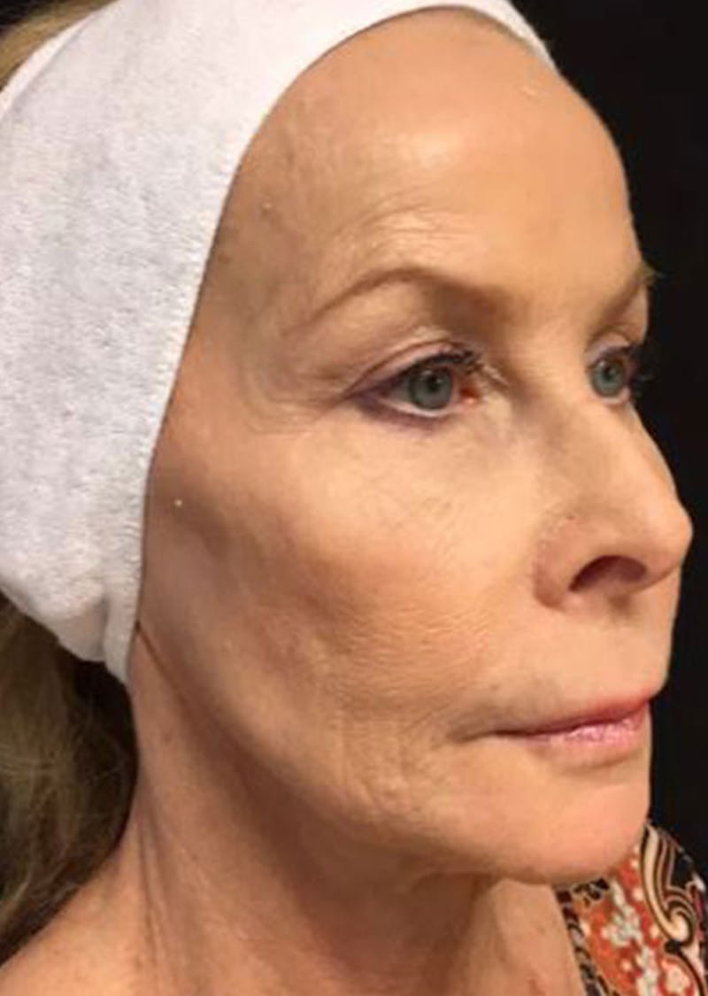 Laser Resurfacing Before & After Gallery - Patient 416910 - Image 1