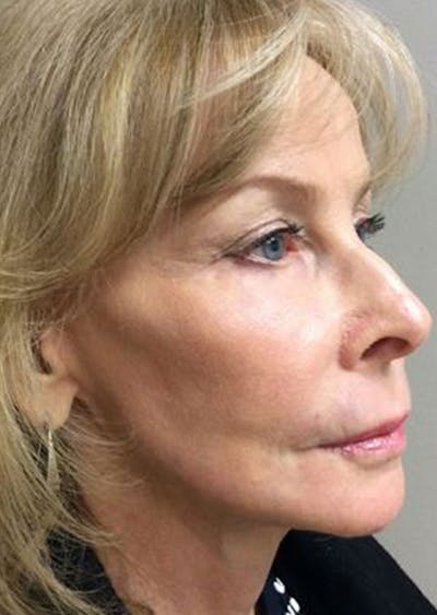 Laser Resurfacing Before & After Gallery - Patient 416910 - Image 2