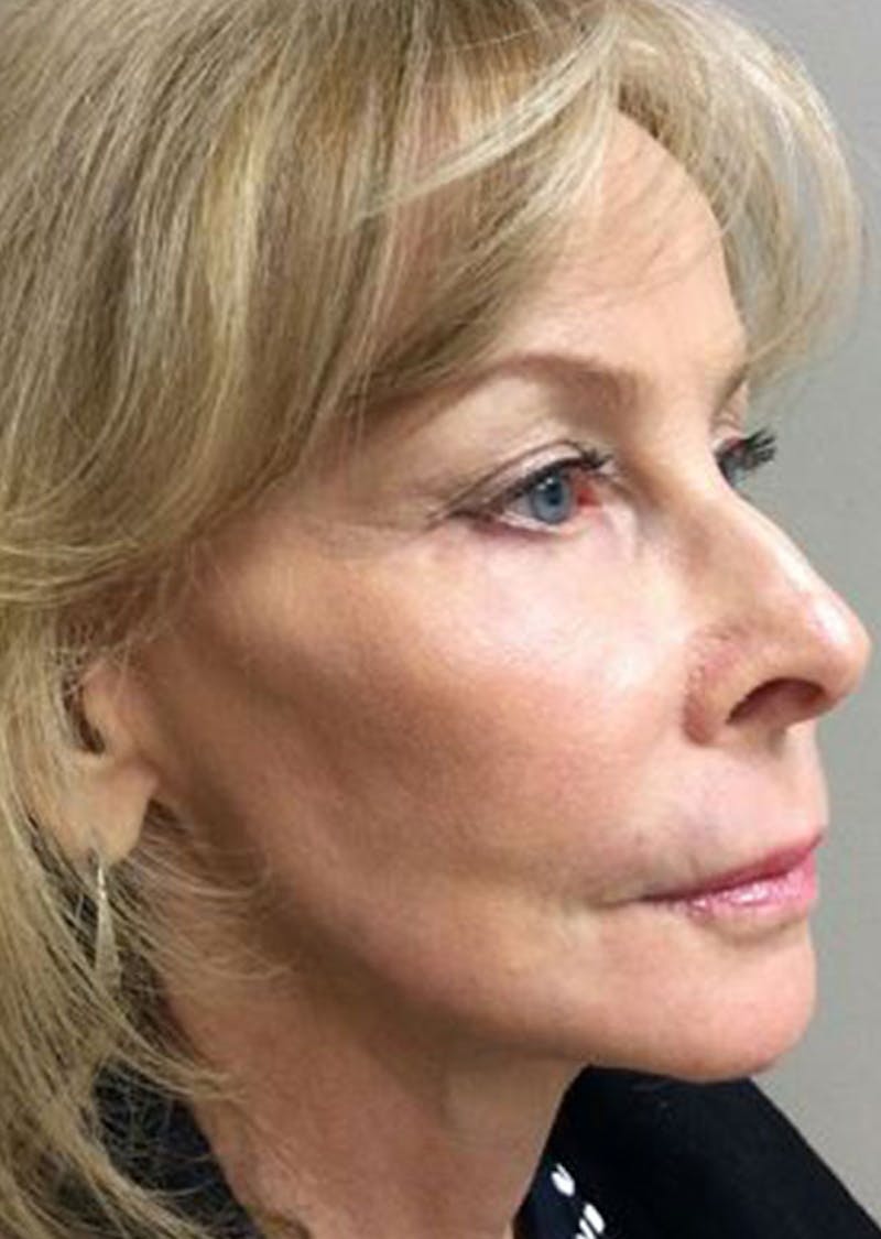Laser Resurfacing Before & After Gallery - Patient 416910 - Image 2