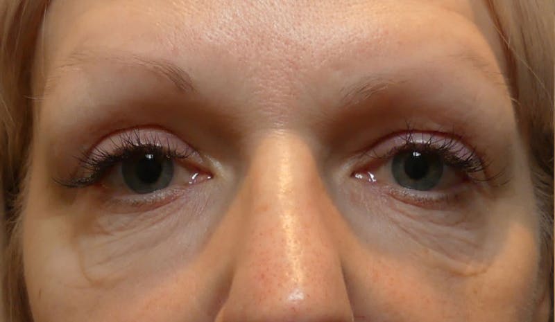 Morpheus8 Before & After Gallery - Patient 129359 - Image 1