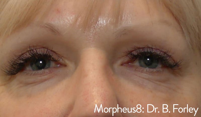 Morpheus8 Before & After Gallery - Patient 129359 - Image 2