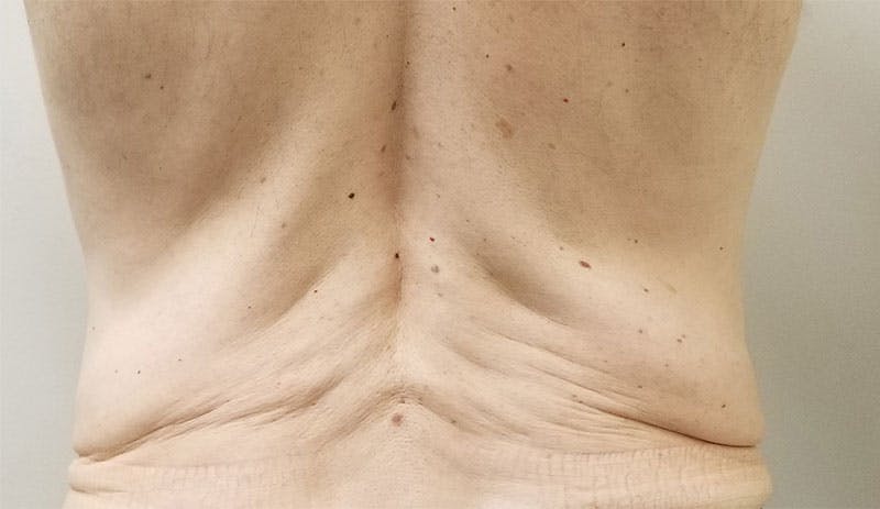 Morpheus8 Before & After Gallery - Patient 215221 - Image 1