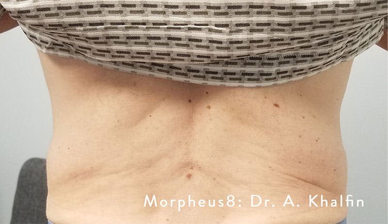 Morpheus8 Before & After Gallery - Patient 215221 - Image 2