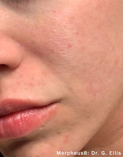 Morpheus8 Before & After Gallery - Patient 183045 - Image 2