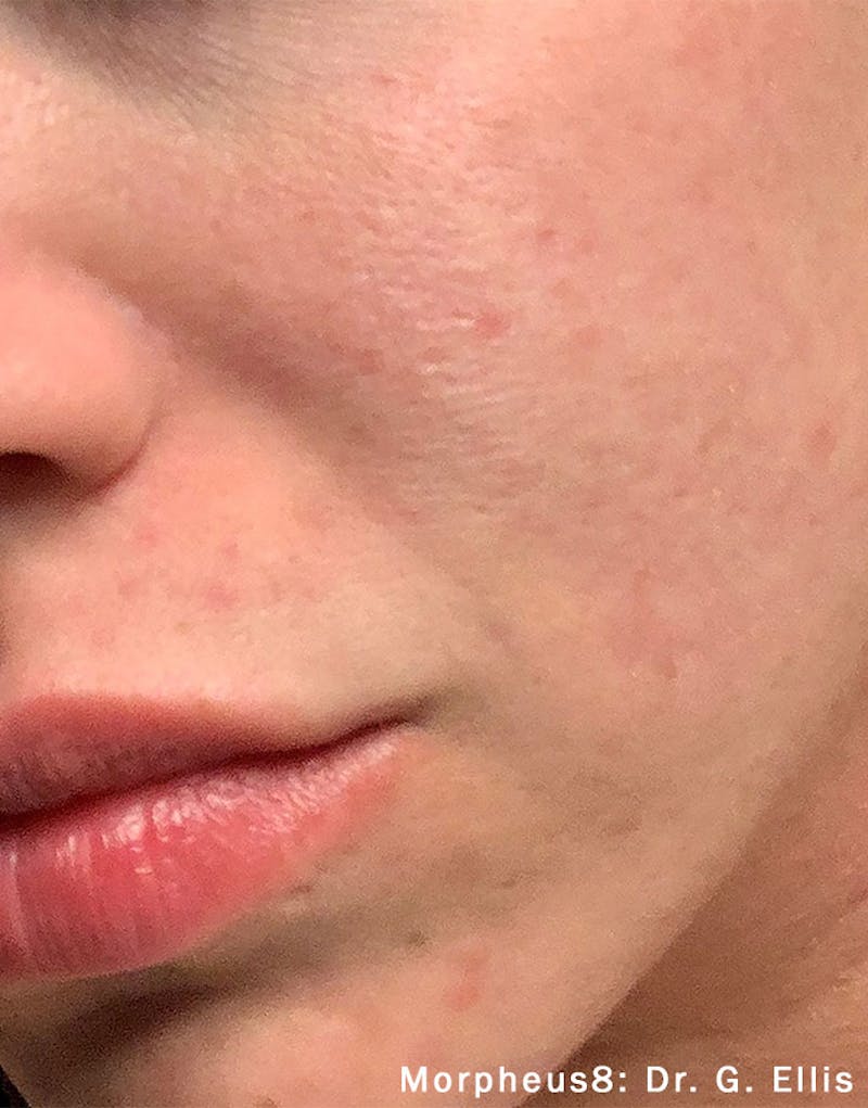 Morpheus8 Before & After Gallery - Patient 183045 - Image 2