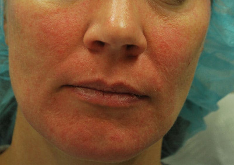 Morpheus8 Before & After Gallery - Patient 126380 - Image 1
