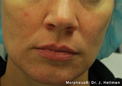 Morpheus8 Before & After Gallery - Patient 126380 - Image 2
