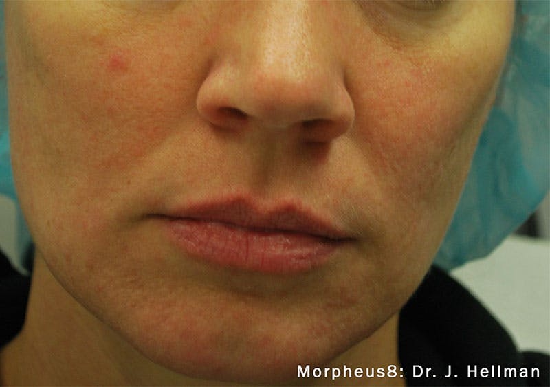 Morpheus8 Before & After Gallery - Patient 126380 - Image 2