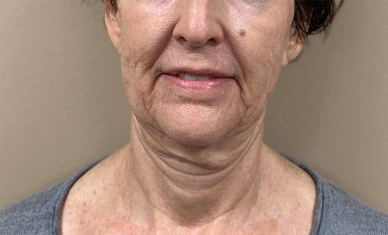 Morpheus8 Before & After Gallery - Patient 104095 - Image 1