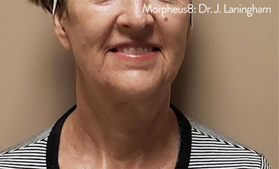 Morpheus8 Before & After Gallery - Patient 104095 - Image 2