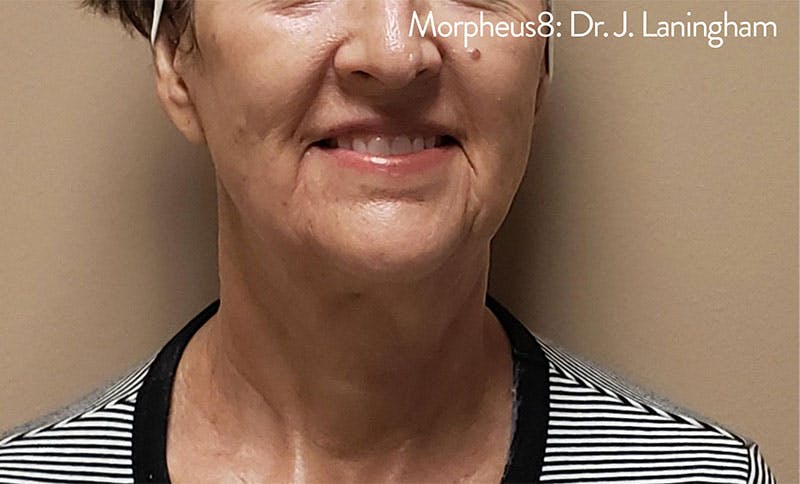 Morpheus8 Before & After Gallery - Patient 104095 - Image 2