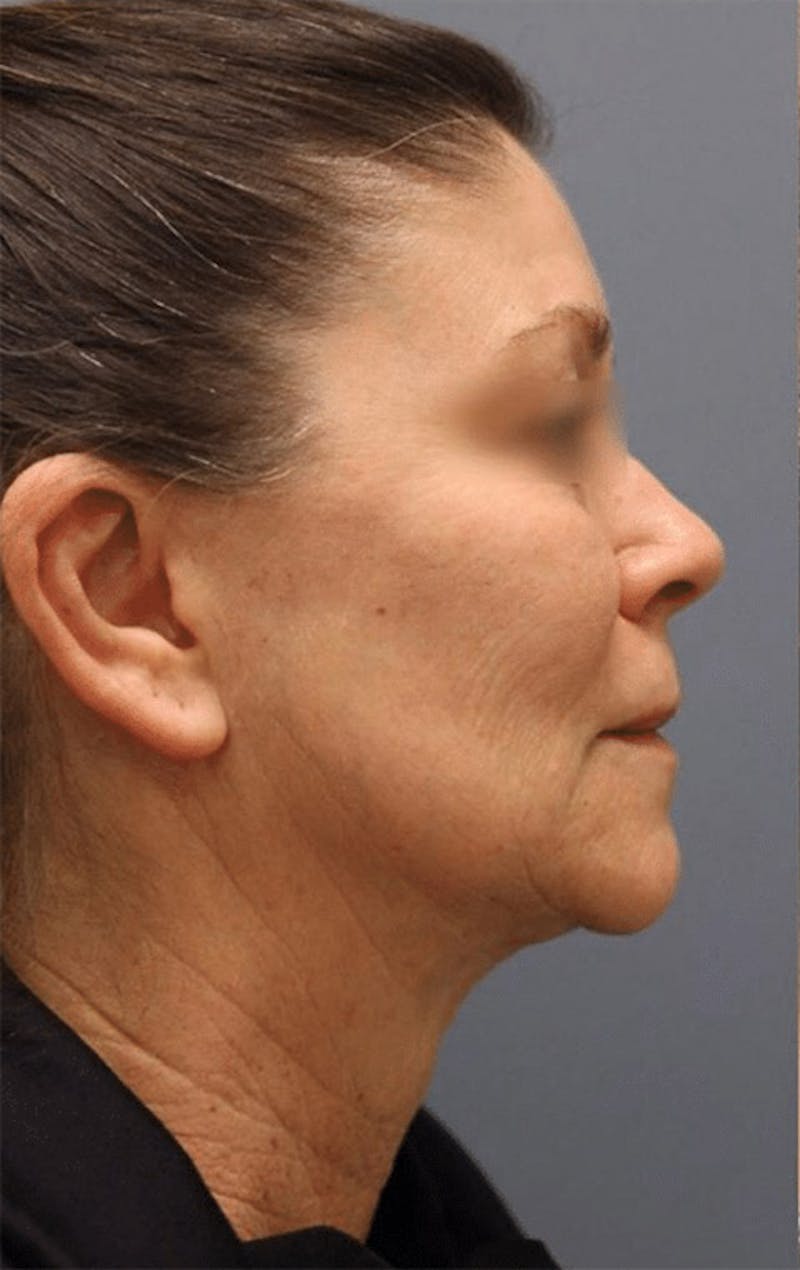 Pixel-8 RF Before & After Gallery - Patient 333465 - Image 1