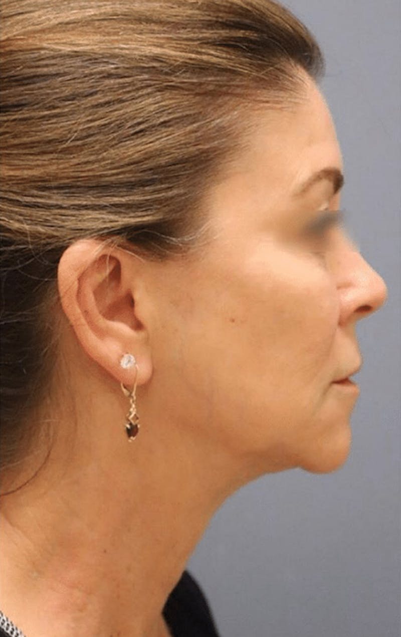 Pixel-8 RF Before & After Gallery - Patient 333465 - Image 2