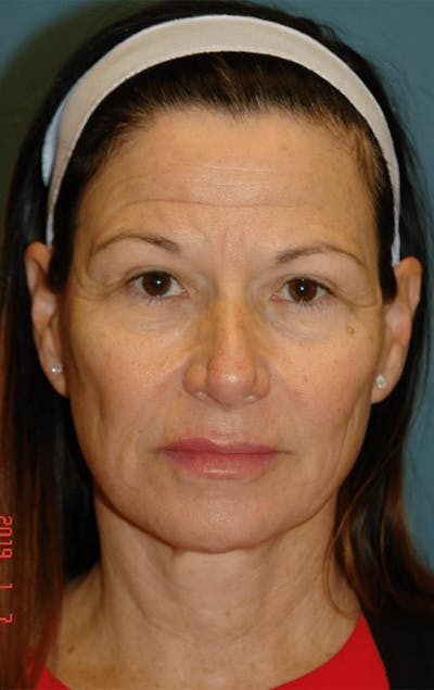 Pixel-8 RF Before & After Gallery - Patient 563977 - Image 1