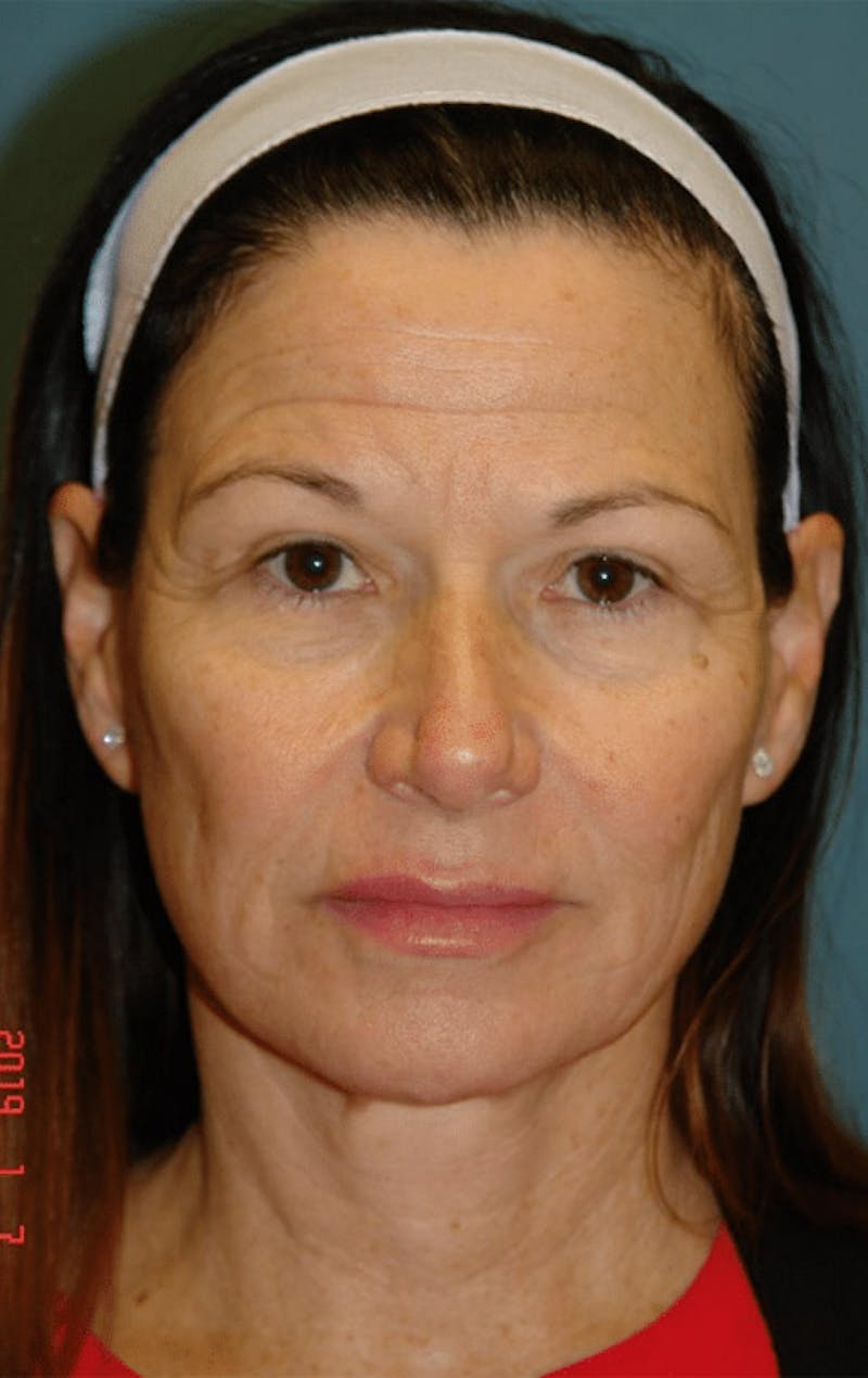 Pixel-8 RF Before & After Gallery - Patient 563977 - Image 1