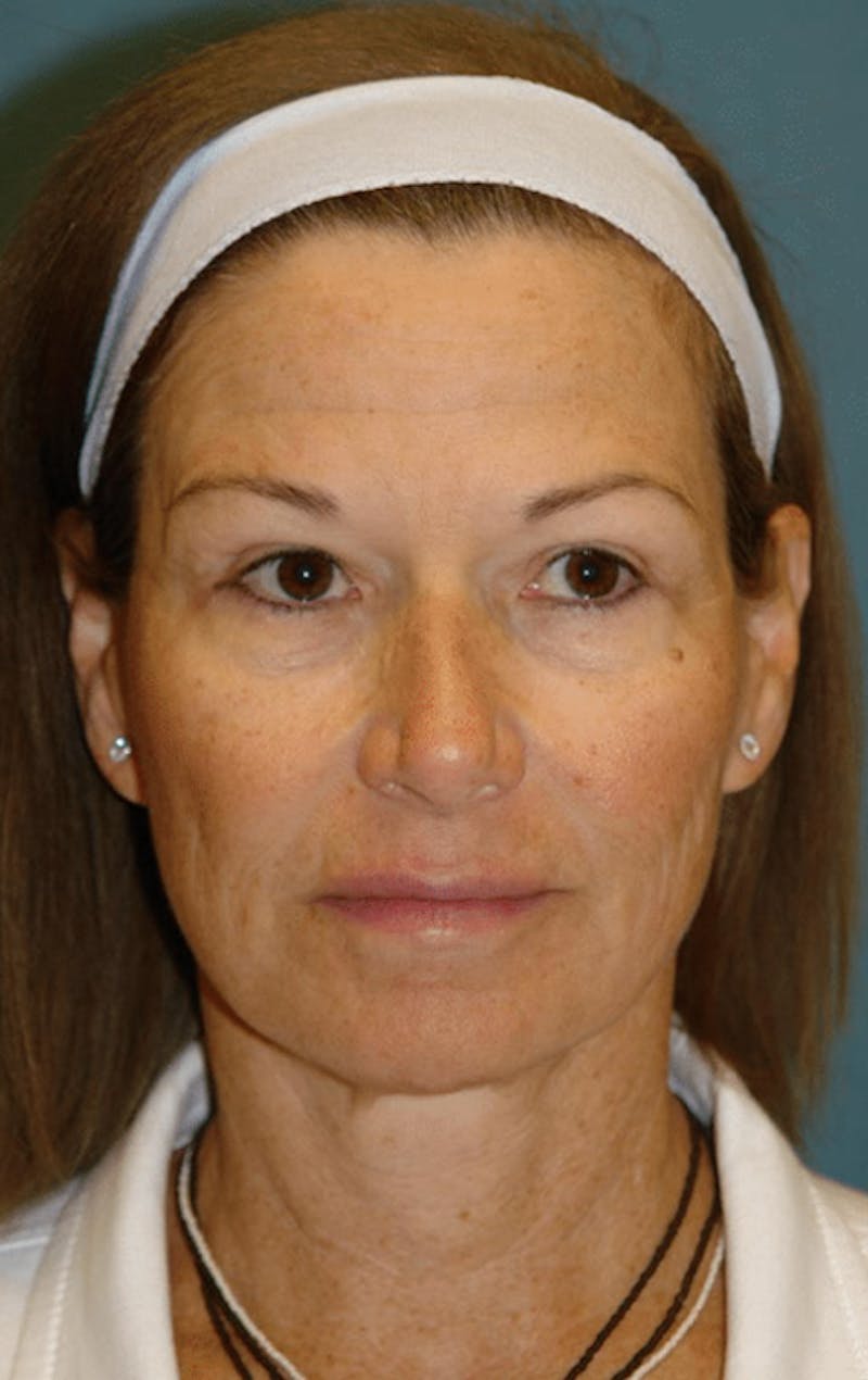 Pixel-8 RF Before & After Gallery - Patient 563977 - Image 2