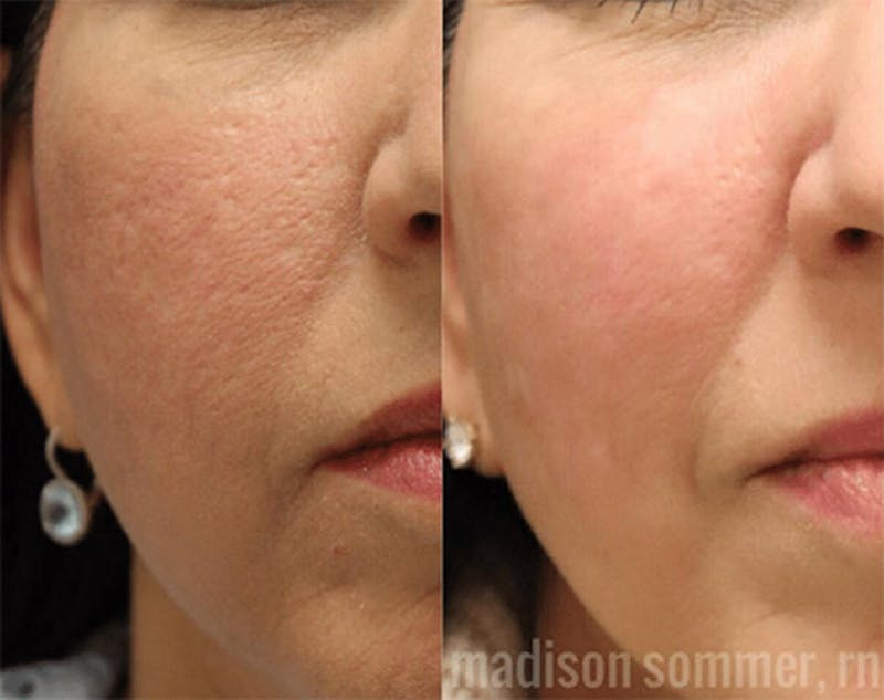 Pixel-8 RF Before & After Gallery - Patient 253481 - Image 1