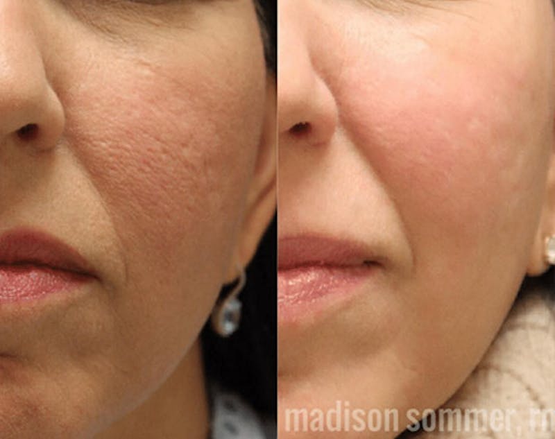 Pixel-8 RF Before & After Gallery - Patient 253481 - Image 2
